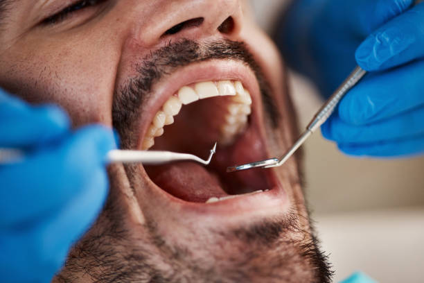 Best Emergency Treatment for Dental Infections or Abscesses in Saxon, SC
